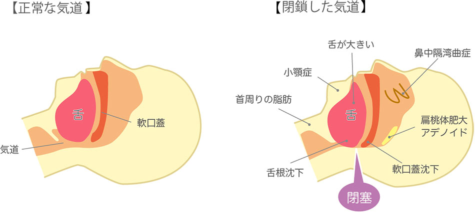 睡眠時無呼吸症候群イメージ