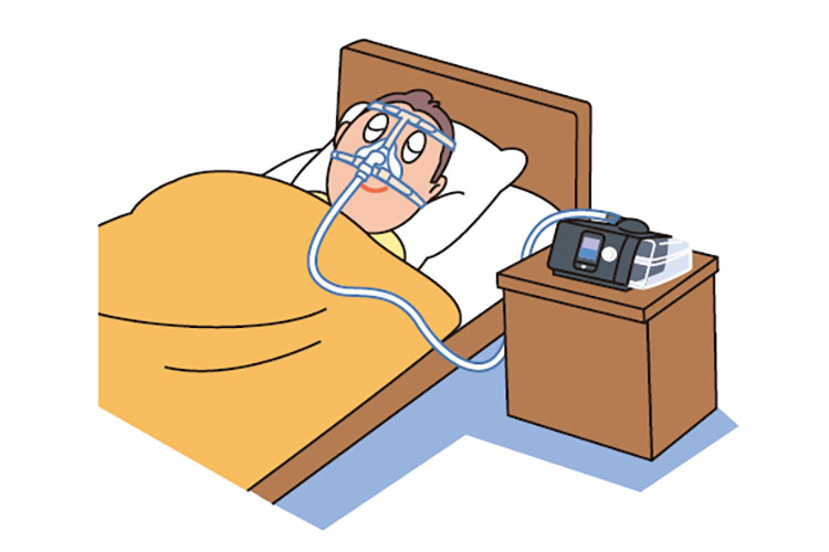 睡眠時無呼吸症候群イメージ